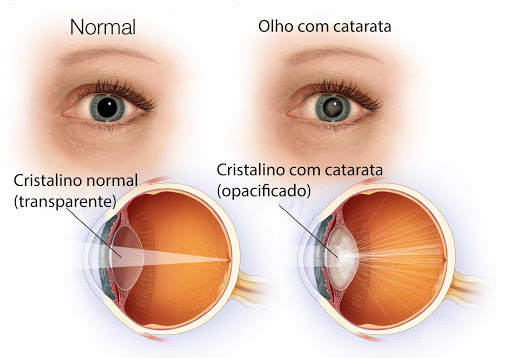 Catarata: cinco dicas para identificar primeiros sinais de perda da visão