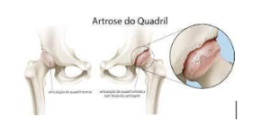 Presidente Lula: problema de artrose no quadril e como é feito o tratamento