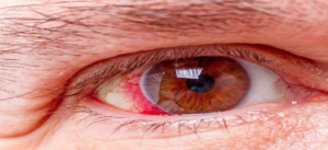 Glaucoma: Citicolina é capaz de reduzir a progressão