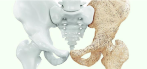 Osteoporose: especialista responde às principais dúvidas